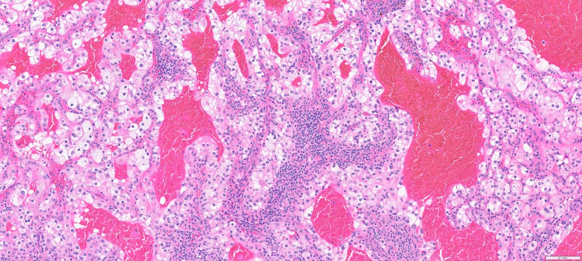slusagar's tweet photo. #GUpath nephrectomy classic:
clear cell RCC:
delicate chicken🐔wire vasculature with chronic inflammatory cells riding the vessels
nearly identical 📸seen in testicular seminoma! https://t.co/Y7kplPYwyN