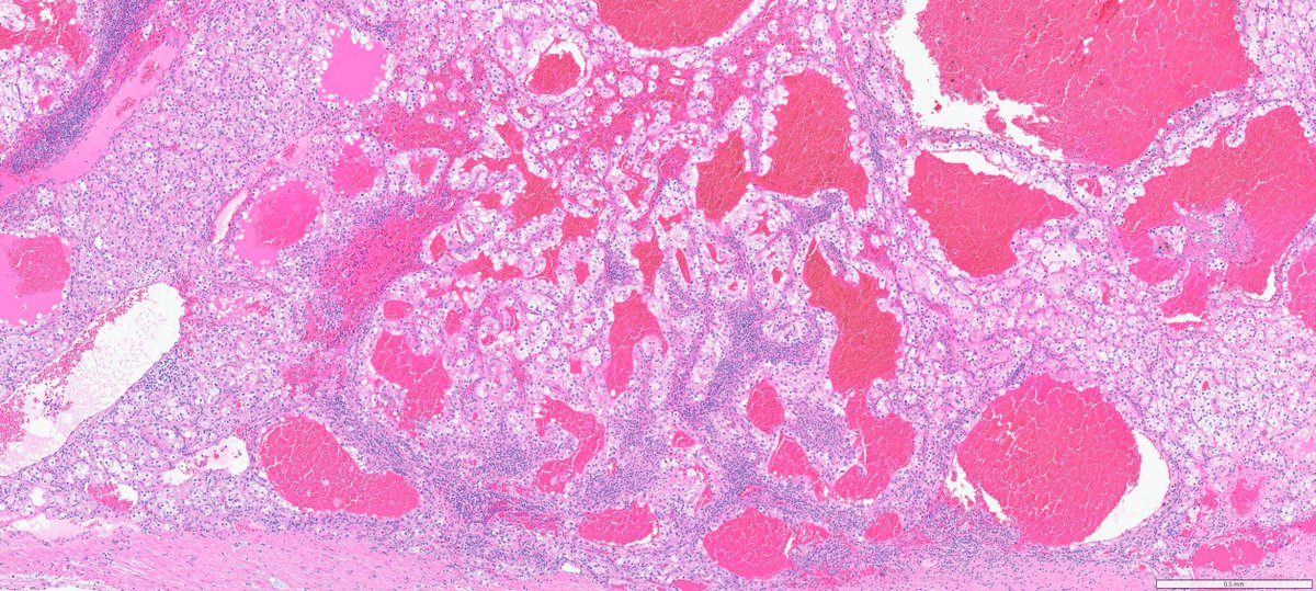 slusagar's tweet photo. #GUpath nephrectomy classic:
clear cell RCC:
delicate chicken🐔wire vasculature with chronic inflammatory cells riding the vessels
nearly identical 📸seen in testicular seminoma! https://t.co/Y7kplPYwyN