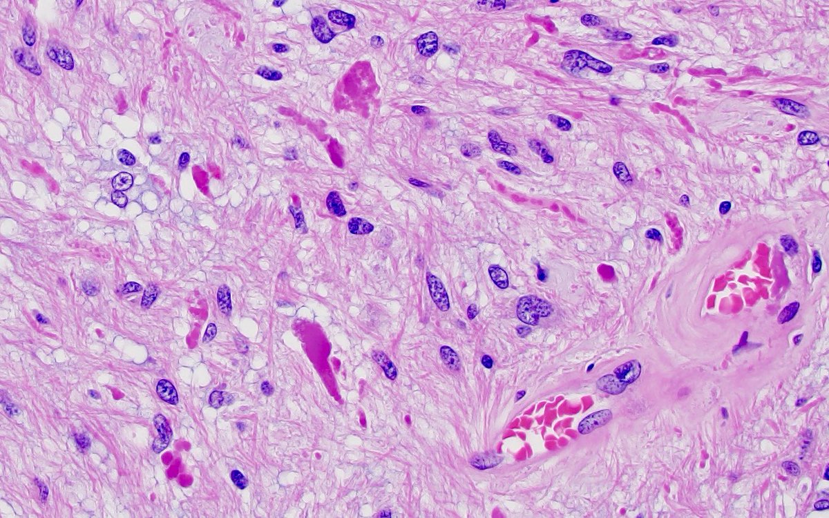 JaredAhrendsen's tweet photo. #PathClassic - cerebellar tumor from a young person. #Diagnosis? Most likely molecular alteration? What are those eosinophilic structures called? 🧐 
#neuropath 🧠🔬 https://t.co/nmiMHtAxzP