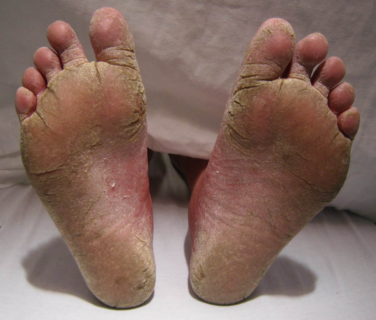 OgoMustapha's tweet photo. Googled to find pictorial representation, I didn't take any picture of my feet during those years. My feet would become so itchy and look like pic 1. Random tears and pus between toes and any part of the sole..pic 2. Thick skin that cracks deep into the flesh easily like pic 3. https://t.co/9QHuWllS3f