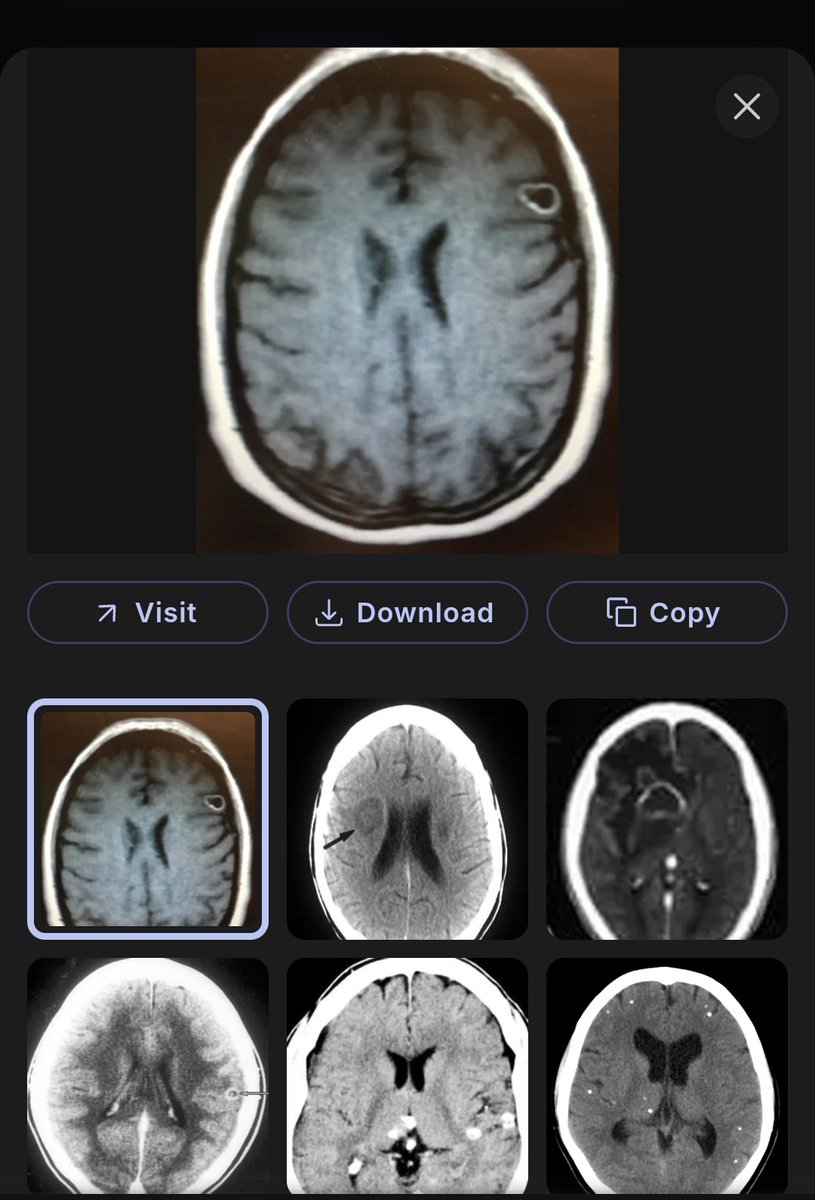 si85856564's tweet photo. @laralogan @GoingRoguewLara @LaurenWitzkeDE @PurgeStore_com Parisites in brain(uptick dementia  in 40s on up). Also researched the same with parasites in lungs and cancer(look identical).
  Less profit medically to rid parasites , Cancer is very profitable. https://t.co/jfnLYtwggf