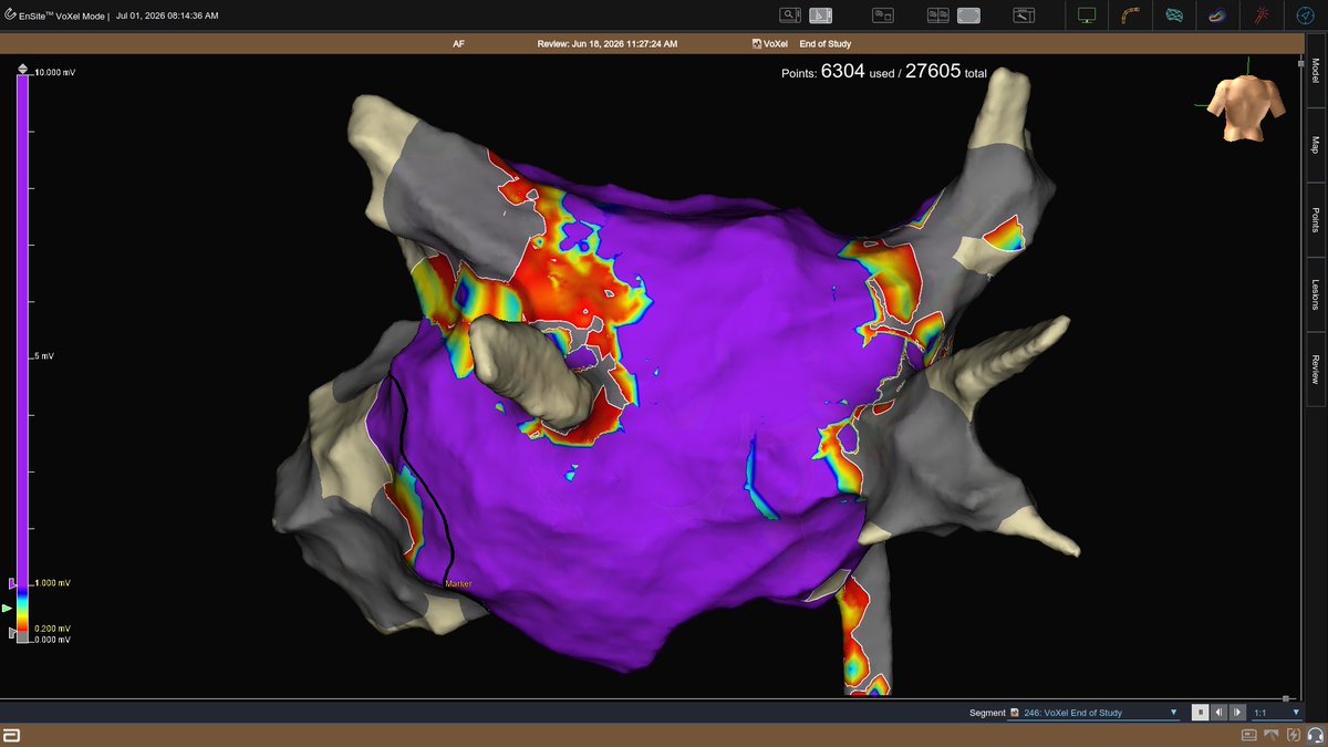 EPWaveDoc's tweet photo. Recent PVI and CTI ablation in 35 y/o patient with truncating TTN variant. Normal LVEF. Normal LVEDD. Normal voltage. AF and AFlu known for more than 8 years. CMR scheduled. What’s your experience with genetic 🧬 AF, #Epeeps? Interesting paper https://t.co/WPnqMr0fS7 https://t.co/FVzauQ0PyN
