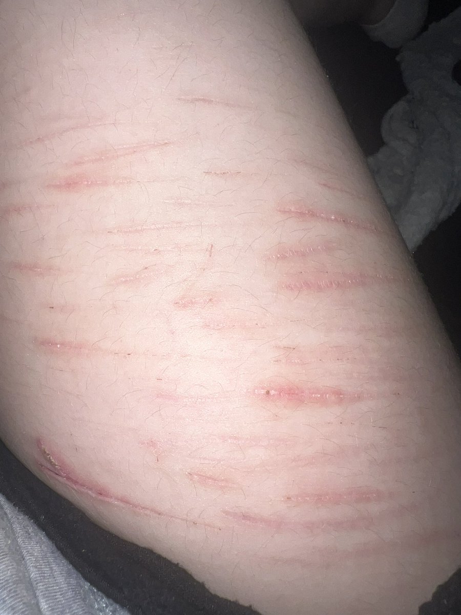 Charlie_fwa's tweet photo. Mc loving my scars , is it just me or do I hate how keloids look.. I like it when the skin kinda like, has a line where it’s lower than the rest? If that makes sense.. #shedtwt https://t.co/Sx5lnM7DPK