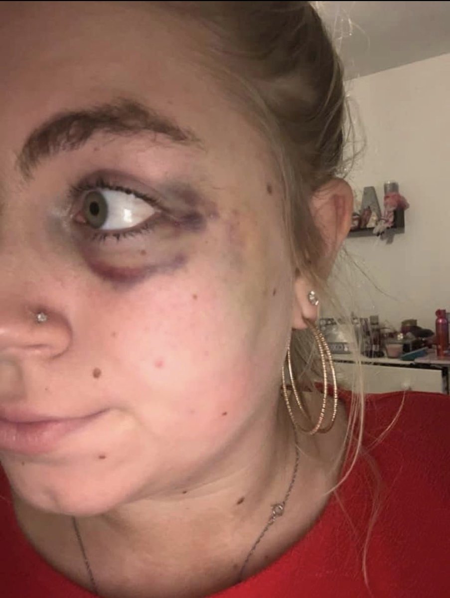 abbyboharrison's tweet photo. If @itvcorrie is awareness for seizures I will cry in happiness. The one seizure turns your life upside down and people just say “only it’s a seizure”! unconscious and bruised broken bones. #Swarla 
So thankyou to @VixMyers  @sydneymartin_x  @itvcorrie  @ITVX @epilepsysociety https://t.co/rltH4pNAlM