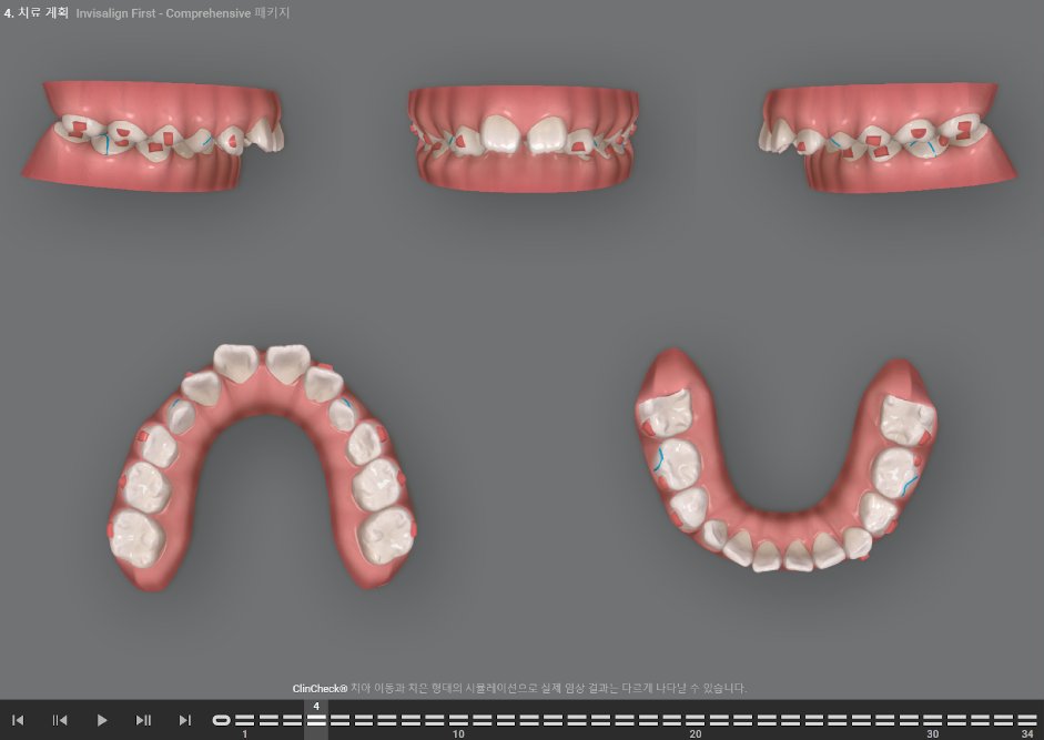hypeortho's tweet photo. Class II elastics pulling your aligner off the upper posterior?

The answer isn't stronger elastics.

It's attachment placement that counters the elastic vector. https://t.co/7z7KEMQdAe