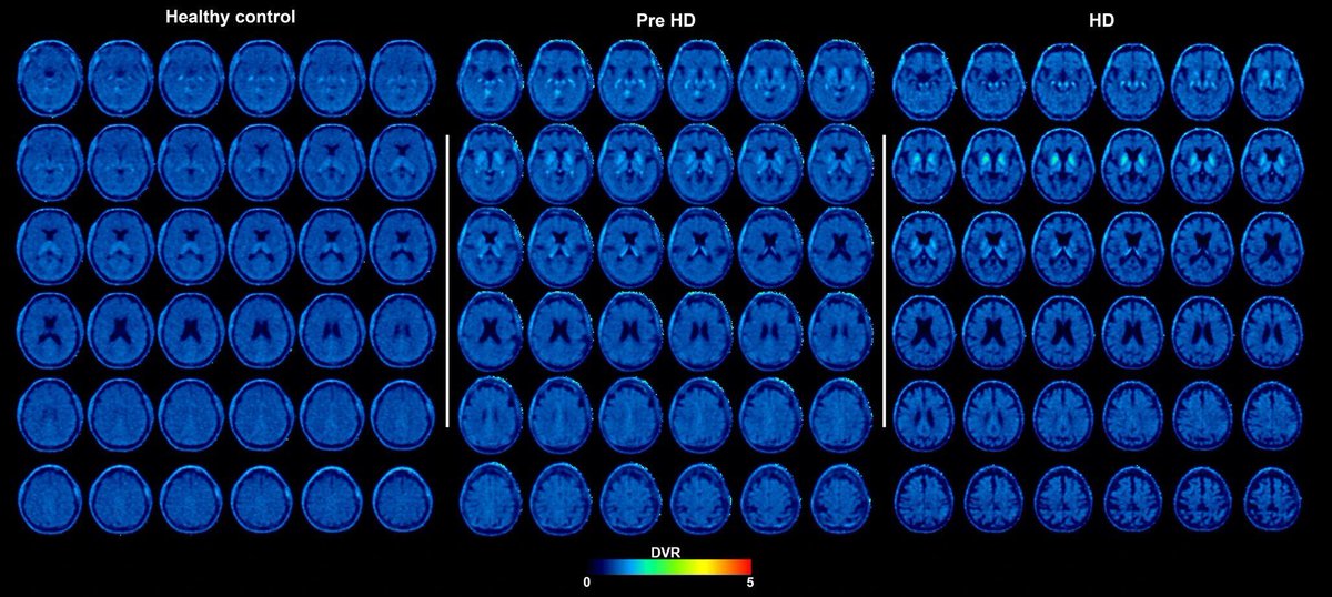 jonlieffmd's tweet photo. Huntington's disease show that a tau-related biological process is already present before manifest disease develops and that it follows a clearly defined anatomical organization, particularly in certain subcortical regions, https://t.co/NDB0ZJAHML https://t.co/UR8hs2MjAZ
