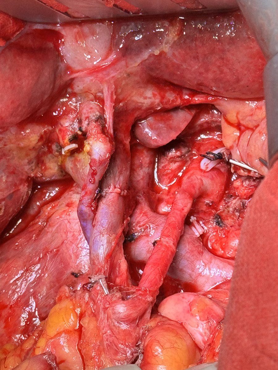 JasSamra8's tweet photo. PDAC at pancreatic neck, invading CA and narrowing SMV/ PV junction, occlusion of SV. Splenic art embolisation, stent in PV/SMV. SVG graft to HA, resection of PV/SMV and TP. R &amp; L crus, hepatic artery Froz Sect negative before proceeding. ICG to determine gastric resection line. https://t.co/PV5ctJKaUP