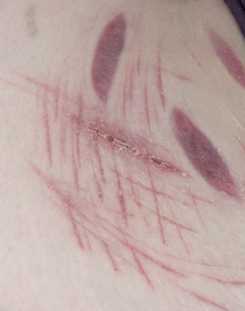 pineaplepusheen's tweet photo. i cant wait till this is fully healed so i can put lotion on it cuz its so gross atm like idek why https://t.co/WWBW6dXSwQ