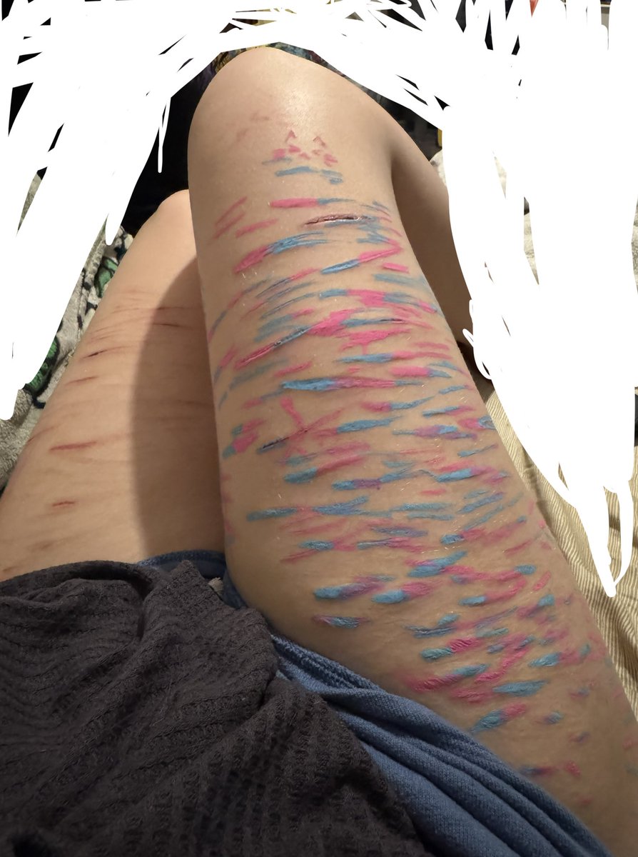 SchlattOfSh3dtw's tweet photo. Got rlly high and colored in my scars 🤔 https://t.co/2eNXEir6Vy