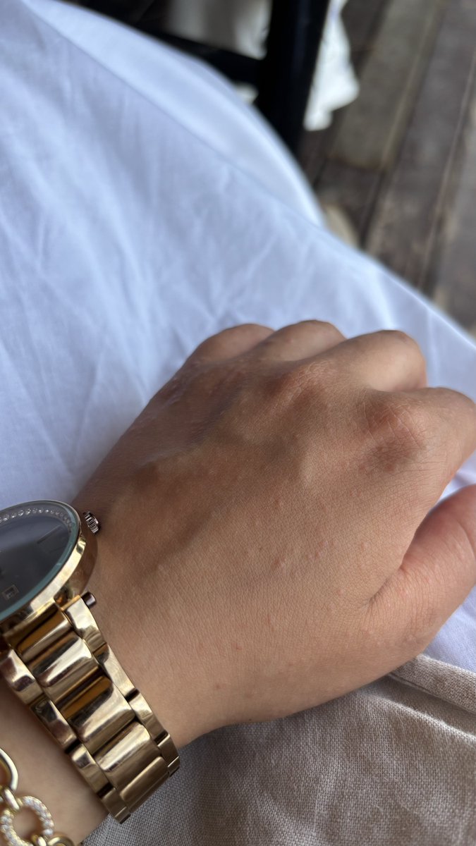 ferideehanimm's tweet photo. güneşe alerjisi olan kızın Antalya sıcaklarıyla imtihanı.. sonuçlar ektedir 🤝🌞 https://t.co/qobwZ32t8P