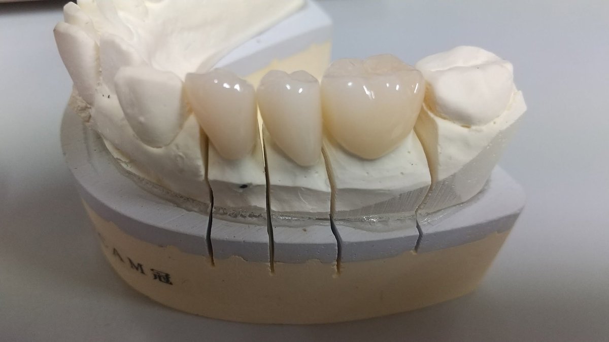 tabedc's tweet photo. #保険でも白い歯　が入れられます お問い合わせください （但し噛み合わせ、食いしばりの強い方は不向きです・また自費診療による白い歯よりも耐久性・審美性に劣る部分はございますのでカウンセリングをお受けいただき選択される事をお勧めします #CADCAM　＃小伝馬町 https://t.co/bkfjXcneLl