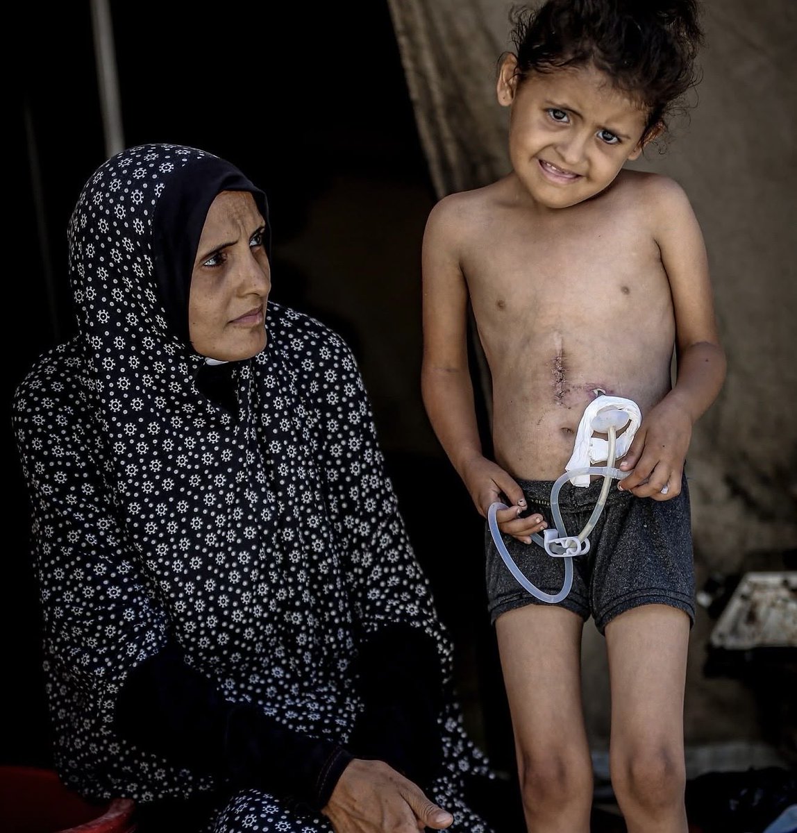 yousef_ki1's tweet photo. Urgent Appeal to Save the Life of Najwa Haggag‼️

We appeal to the World Health Organization (WHO) to intervene immediately to secure an urgent medical evacuation for this little girl. 
She suffers from severe esophageal stricture and weighs only 9 kg (approximately 19.8 Ibs). https://t.co/rAyk9uG2LI
