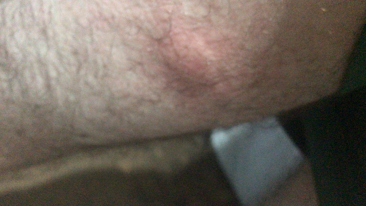 M89Gabriel's tweet photo. @jameswebb_nasa Já tomei uma mordida dessa merd… deitei em uma rede em um sitio e esqueci de sacudi. Uma das piores dores q já senti, minha perna chegou a ficar dormente https://t.co/c4ieSVLkM8