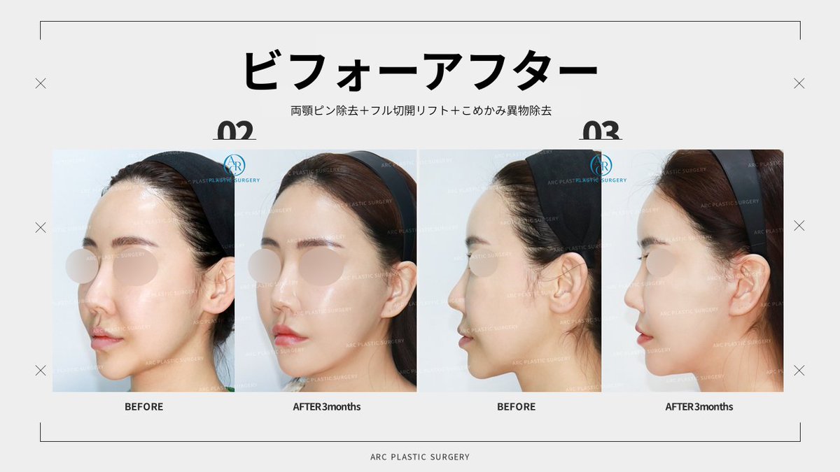 ARC_ps_'s tweet photo. ╭━━━━━━━━━━━━━━━━━━━━╮
🦴『ピンを取るだけ』では、終わらせない。
ARCが目指すのは『フェイスラインの再現』✨
╰━━━━━━━━━━━━━━━━━━━━╯

「ピン除去だけ受ければ十分ですか？」
「リフトは後からでもいいですか？」

実はこのご質問、とても多くいただきます📩
そこで以前ブログでも詳しく解説しました👇
💙『別々にした方が効果が高い』は本当？
💙『ARCがピン除去・シェービング・切開リフトを同時に行う理由』

今回は、その考え方がよく分かる症例をご紹介します📸✨

━━━━━━━━━━━━━━━

こちらの患者様は
🦴両顎ピン除去
🦴フル切開リフト
🦴こめかみ部位異物除去
を同時に施術✨

わずか3か月で…
💎ぼやけていたフェイスラインがシャープに
💎頬から顎へのラインがより滑らかに
💎横顔のEラインや首との境界もすっきり

『骨』だけではなく
『軟部組織』まで整えることで、顔全体の印象が大きく変化しています🥹✨

━━━━━━━━━━━━━━━

実は、輪郭手術後に気になる
✔️フェイスラインのもたつきほうれい線
✔️ジョールファット
✔️二重顎
✔️首との境界が曖昧になる

これらは『ピン』が原因というより、
骨格が小さくな��たことで
皮膚・脂肪・SMASは元の位置に残り、
軟部組織とのバランスが変化して起こるケースも少なくありません😅

だからこそARCでは、『ピンを抜くこと』ではなく、
『骨格と軟部組織を同時に再設計すること』
を大切にしています👨‍⚕️✨

🌿剥離を何度も繰り返さなくて済む
🌿ダウンタイムを1回にまとめられる
🌿渡韓回数や麻酔回数も減らせる

海外からご来院される患者様にとっても、大きなメリットがあります✈️🇰🇷

━━━━━━━━━━━━━━━

ARCが考えるゴールは、『ピンを取ること』ではありません。
✨昔の輪郭手術後に変化したフェイスラインを改善すること。

そのために必要であれば、
🦴ピン除去
🦴骨シェービング
✨ミニ切開リフト
✨フル切開リフト
✨魔女顎
✨顎下筋肉縛り

までを一つの治療として組み合わせ、ご提案しています💙

━━━━━━━━━━━━━━━

骨格だけを見るのではなく、
皮膚・脂肪・SMASまで含めてデザインする。

それがARC美容整形外科が目指す
『フェイスライン再建』で��🏥✨

「ピン除去したい」
その先にある、本当に理想のフェイスラインまで一緒に考えてみませんか？🥹🩵

📩輪郭ピン除去・輪郭再手術・切開リフトのご相談は、お気軽にLINEまで💙
日本語可能LINE ➡https://t.co/pchZi84SLE

#ARC美容整形外科  #切開リフト #SMAS #ウルセラ #形成外科専門医 #アンチエイジング #韓国美容 #リフトアップ #フェイスリフト #フル切開リフト #ミニ切開リフト #SMASリフト #ディーププレーン #リフト