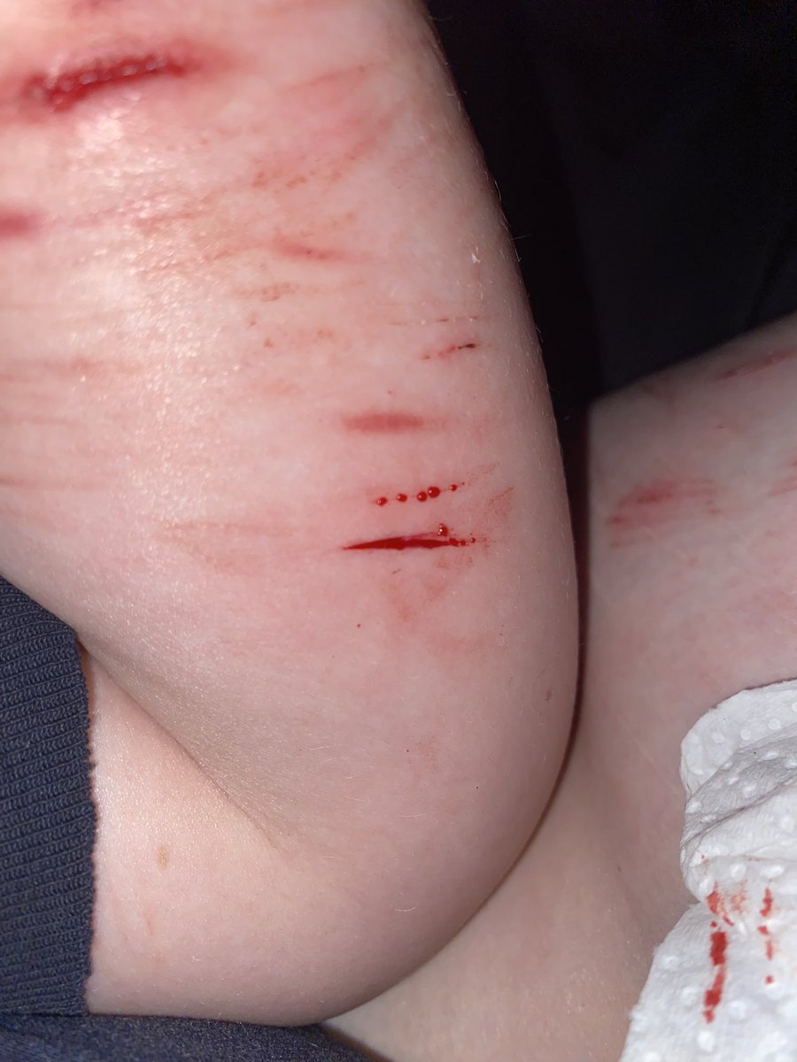 PsychoBixches's tweet photo. Fake body SFX makeup
Why do all my blades suck
#sh #shedtwt #slittwt #babybeans #beanstwt #988twt #selfharm https://t.co/URihlsszqx