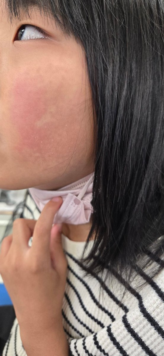 na_o320's tweet photo. 次女ちゃん
りんご病🍎になっちゃった💦
熱もなく元気なんだけどね😄
りんご病の特徴の、ほっぺが真っ赤……
体も赤くなってる😭 https://t.co/CTDF7b7I6Z
