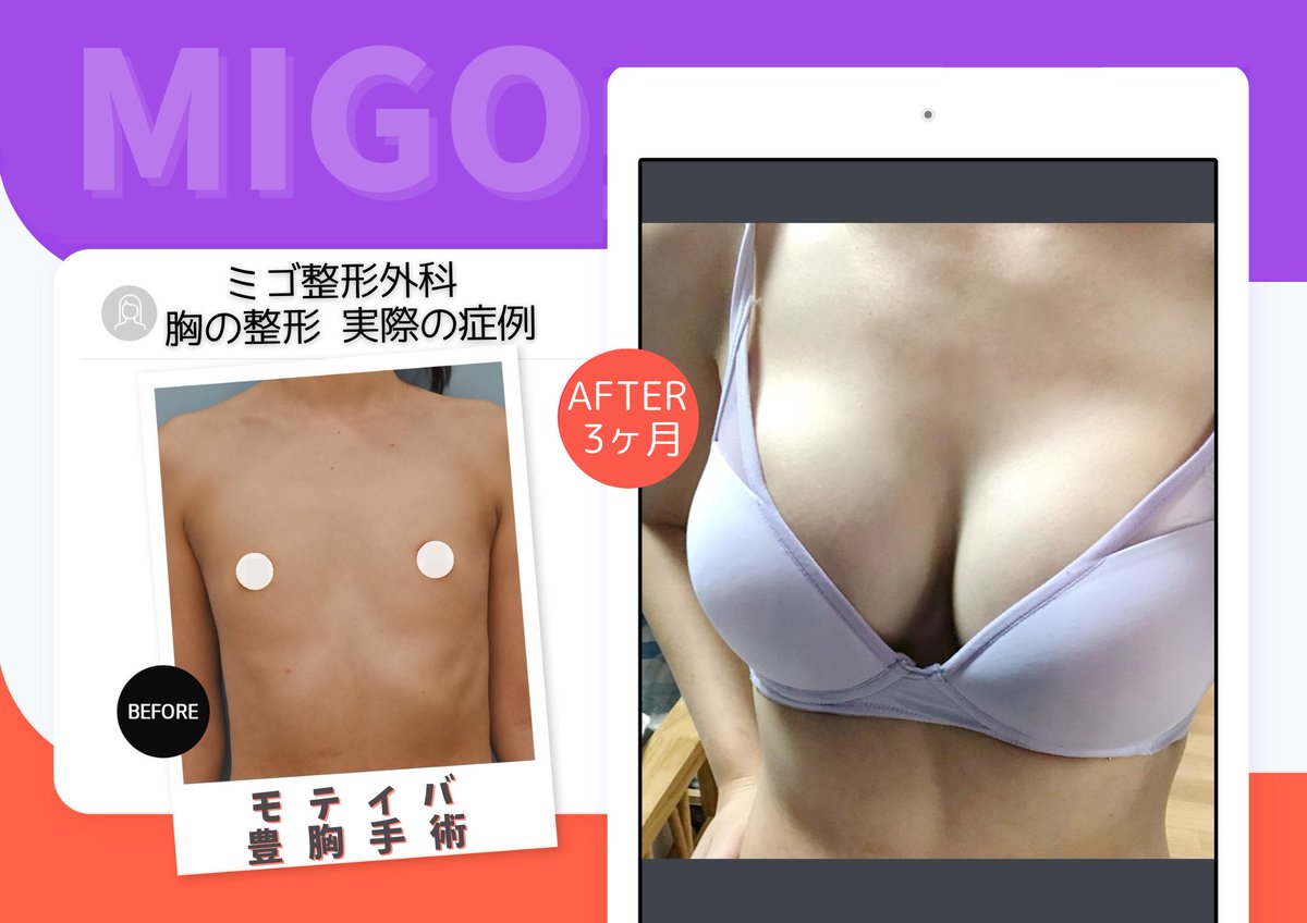 migops_jp's tweet photo. 【モティバ豊胸3ヶ月のリアル✨】

豊胸で一番心配な「いかにも整形しました！」という不自然さをなくすヒミツは、先生の丁寧なポケット作り（剥離技術）にあります👨‍⚕️

元の胸が平らな状態からでも、シリコンを入れるスペースをミリ単位でキレイに広げることで、不自然な段差のない、なだらかで美しいデコルテラインが完成しますライン✨

術後3ヶ月経つと、胸の組織がインプラントにしっかり馴染んでくる時期。モティバの最大の特徴である「立つと自然なしずく型💧、横になるとふんわり広がる丸型🍒」という本物そっくりの動きや、柔らかい手触りがどんどんリアルになっていきます。

左右対称のキレイなバージスライン（胸の下の輪郭）もばっちりキープできていて、理想的な仕上がりです💖

#ミゴ整形外科 #モティバ #豊胸手術
#韓国整形