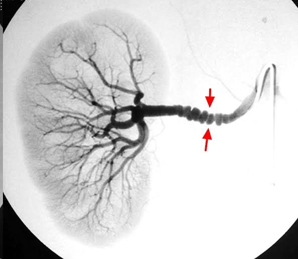 modernHealthMe's tweet photo. Renal angiogram of patient presented with recurrent headaches, tinnitus and Hypertension. 

Diagnosis?? https://t.co/QAEjdLmACn