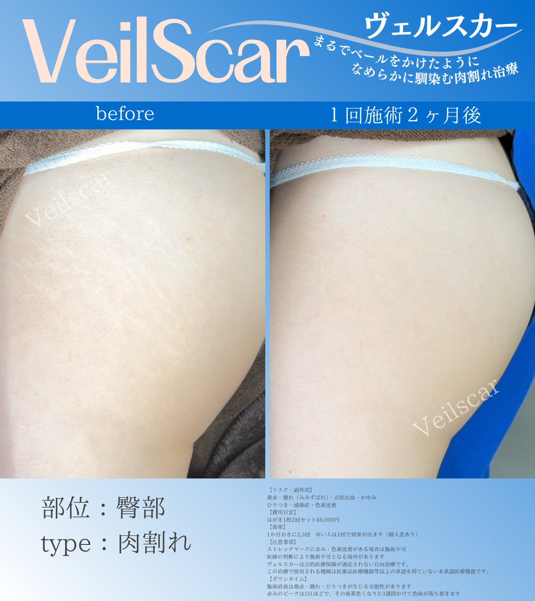 Veilscar_nschan's tweet photo. 【海に行きたい！】
・20代女性
・高校生の頃から気になっていた
・海へ行く予定あり

肌を出す季節、いつにも増して気になってしまいますよね。ダウンタイムがあるので早めに始めるのがオススメです✨ https://t.co/bTvjqUGDDI