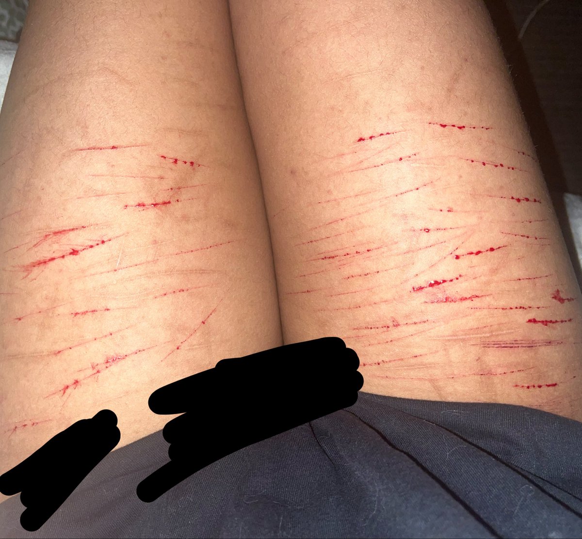 fyozaiscuck's tweet photo. Stupid cat scratches because I'm too lazy to go deeper🫩🫩 #shtwt #selfharm https://t.co/nPiYPwJqPE
