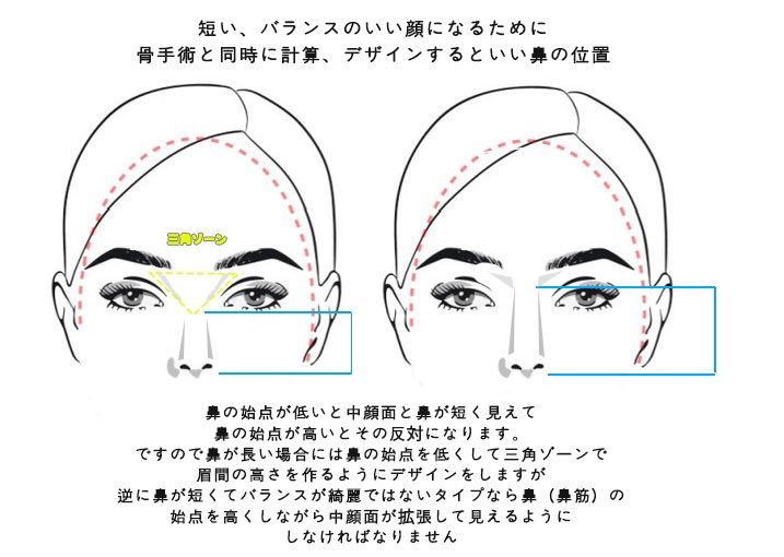 faceline1004's tweet photo. 目・鼻・口の位置やバランスを考えずに顔だけを短くすると、かえって顔全体のバランスが崩れてしまうことがあります。

特に、鼻が長い方や中顔面が長い方は、このようなお悩みが起こりやすいタイプです。

そのため当院では、顔の骨をただ短く・小さくするだけではなく、顔全体のバランスを考えながら自然で美しいフェイスラインをデザインします。

ただし、顔の骨の手術だけでは鼻の長さを短くすることには限界があるため、必要に応じて鼻のデザインも含めて手術計画を立てることが大切です。

✅ 鼻が長く、面長を改善したいタイプ ✅

【鼻の始点（鼻根）の位置が重要】
※鼻の始点が低いと、鼻は短く見えます。
・鼻の始点を低くする
・眉間は三角ゾーンで高さを作る

一方で…
✅ 鼻が短く、中顔面に長さを出したいタイプ ✅

・鼻の始点を高くする

お問合せ・ご予約👇
https://t.co/60ph3eO8oX

症例写真はこちら👇
https://t.co/XjdaMn5lMF

#フェイスライン美容外科 #イジンス院長 #韓国整形 #両顎 #輪郭 #シャクレ口 #オトガイ #歯科矯正