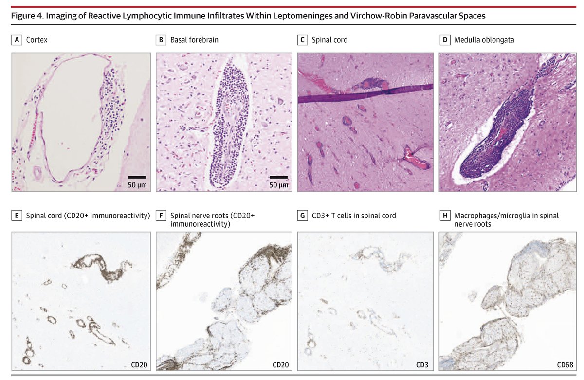 JAMANeuro's tweet photo. In autopsy tissue from patients with #SOD1ALS, intrathecal tofersen achieved predicted central nervous system distribution and substantially reduced SOD1 protein levels in somatic motor system tissues.
https://t.co/kto4Qh1AKX https://t.co/jRVzdoIDa8
