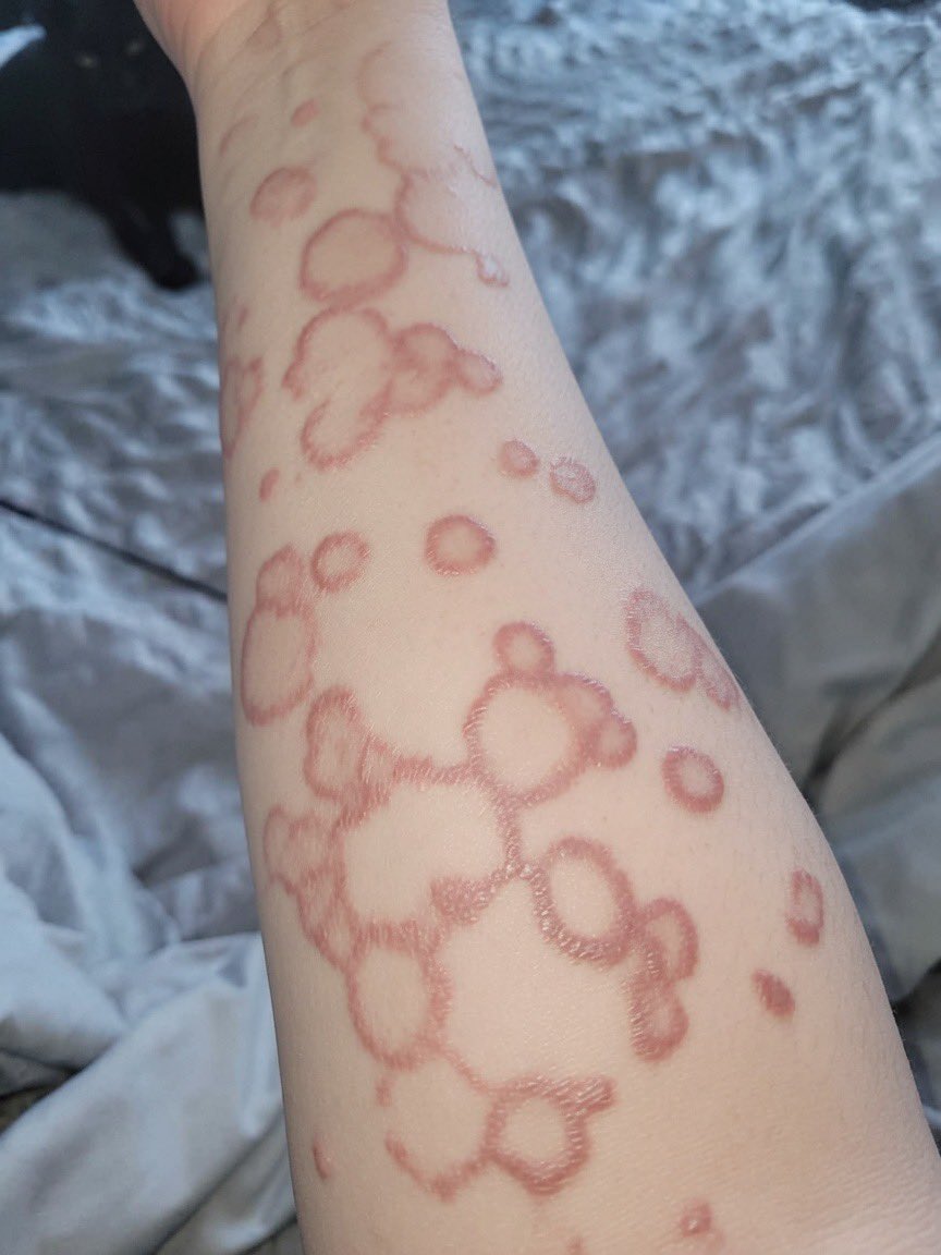 Bella__Bahby's tweet photo. My friend in Canada sent me this after spending time at her man’s place. She woke up with these spots all over her body. 

Does anyone know what could have caused this? https://t.co/fIlldhaUR5