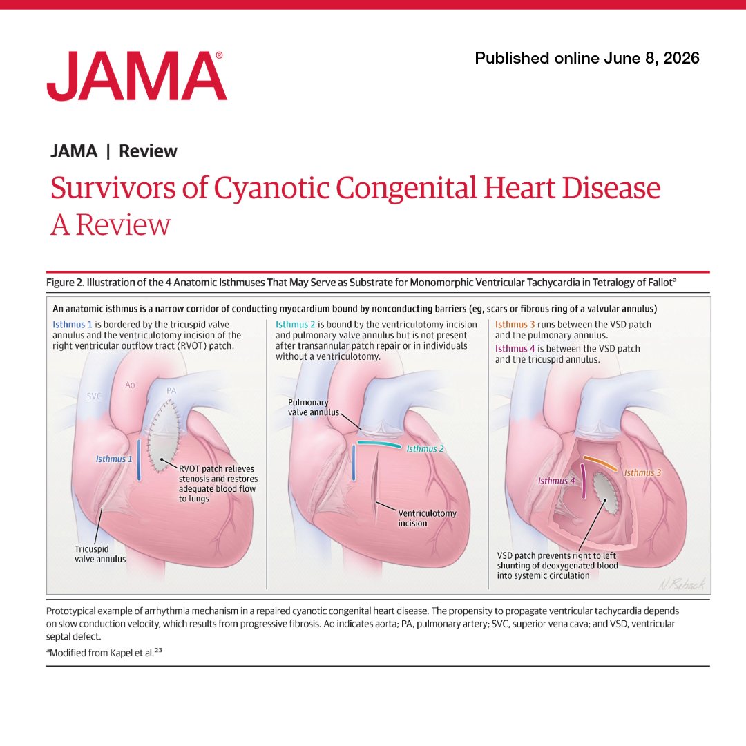 JAMA_current's tweet photo. 📝 #JAMAReview: Congenital #heart diseases (CHDs) are the most common type of major structural birth defects, affecting 0.86% to 1.0% of all live births. 

The diagnosis of #CHD is usually made prenatally based on routine #anatomy #ultrasonography performed between 18 and 22 weeks of #pregnancy; however, CHDs are occasionally diagnosed postnatally.  

https://t.co/EBkYZokE2u