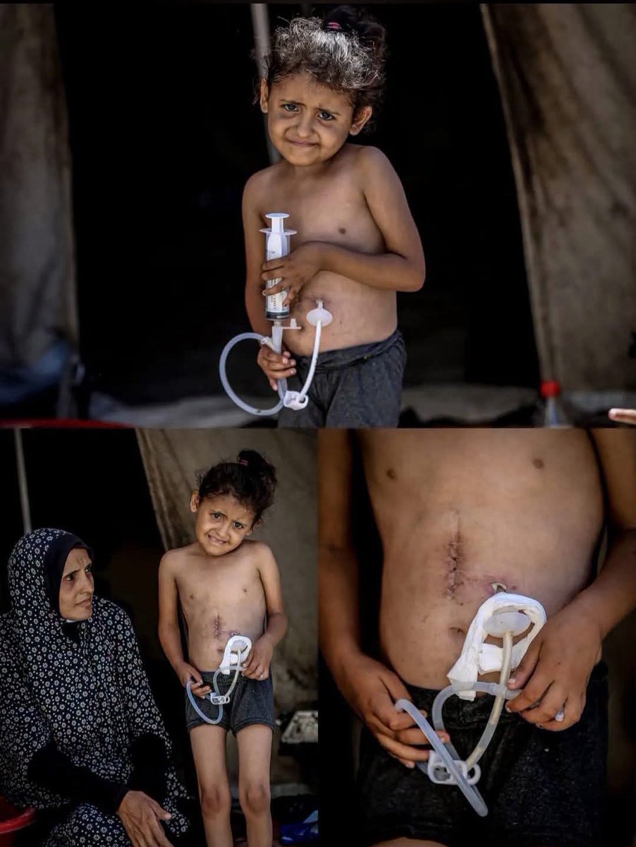 QudsNen's tweet photo. Seven-year-old Najwa Hajjaj urgently needs a new feeding tube, but Israel's blockade and restrictions on the entry of medical supplies into Gaza have prevented it from being replaced. 

The worn-out tube has become a source of severe pain and infection instead of the lifesaving support she depends on.

Via: Hossam Shabat