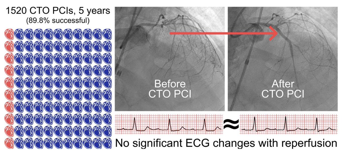 LAzzaliniMD's tweet photo. Can reopening a chronic total occlusion (#CTO) make the heart electrically less prone to #ventricular #arrhythmias?

For years, small studies suggested the answer was yes.

We analyzed 7,496 ECGs from 1,232 patients undergoing 1,520 CTO PCIs using automated Python-based signal analysis.

Here's what we found... 🧵