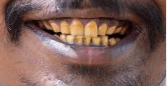 1irissi's tweet photo. What brand of toothpaste do I need to get to clean my teeth from this to that?
Drop your recommendations below https://t.co/s0208s0IHR