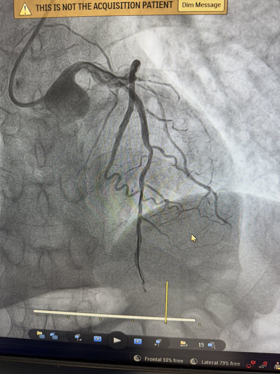 mmamas1973's tweet photo. The problems of having no national thrombolysis program for STEMI- patient presented with a 12 hour history of chest pain and was found to have tombstone ST elevation anteriorly. He was in a town 600 km away. 

He took an 9 hour ambulance trip overnight for ppci at Black Lion Hospital 

He still had chest pain so I performed PCI (21hrs post onset pain) 
Suspect that the benefit will be small

Availability of thrombolysis would have completely changed this man's trajectory. ESC guidelines are if you cant deliver ppci with 120mins, thrombolysis better

We need to roll out STEMI care across the country with STEMI networks and thrombolysis.

@HeartAEthiopia @TTelila @drmerid case performed with @adane_petros8