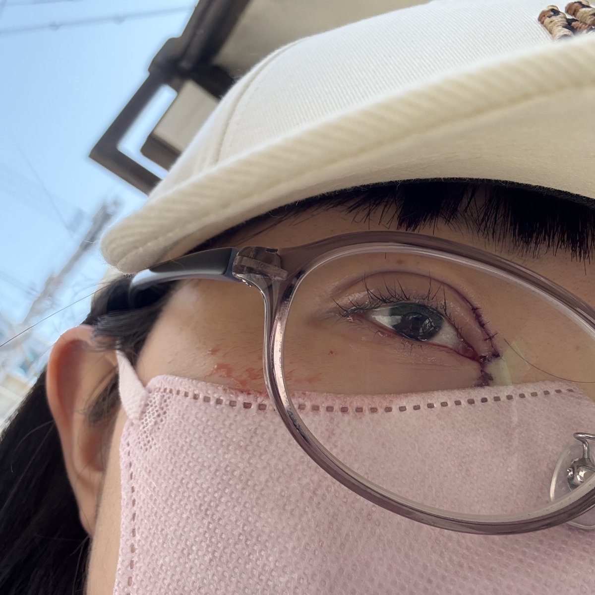 811_73's tweet photo. 二重埋没と目頭切開直後です🥹
耐えられる痛みだったのでメガネと帽子をかぶって電車で帰りましたჱ̒ ᴖ⩊ᴖ ） https://t.co/nt0nwkslxD