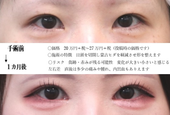 drmatsui's tweet photo. 一番違うのはメイクなのは確かですが、ここでは目頭の変化をしっかりと見ていきましょう。
ヒダ感を減らし、隠れていた奥の部分を出していく目頭切開。
特に左目が斜め方向→横方向といった感じに目の印象を変えています。
＃目頭切開 https://t.co/QKtwKFqG3q