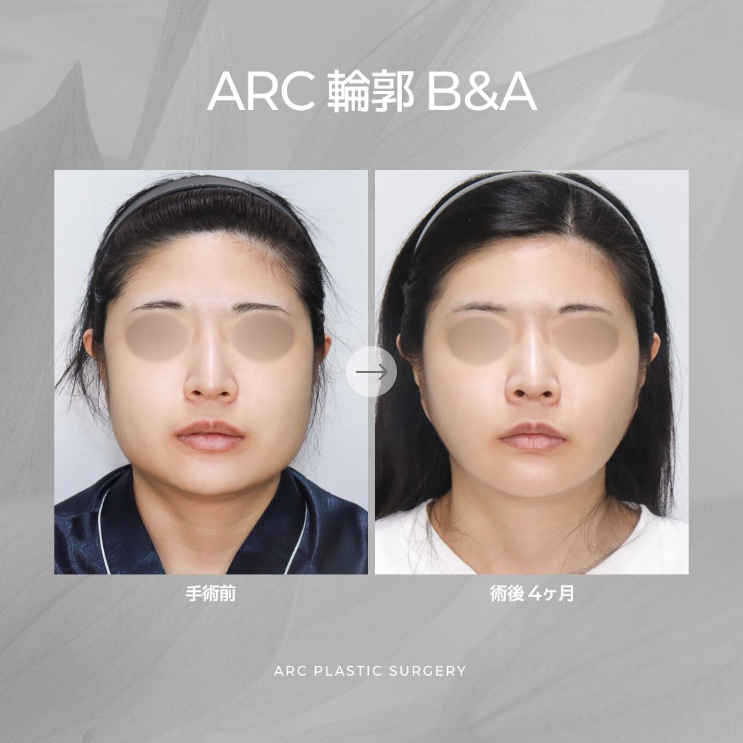 ARC_ps_'s tweet photo. ╭━━━━━━━━━━━━━━━━━━━━╮
🎊✨『ARC美容整形外科 5周年記念』✨🎊
╰━━━━━━━━━━━━━━━━━━━━╯

輪郭専門病院として、
5年間、技術だけを磨き続けてきま���た。

そして今――

皆様への感謝を込めて
ARCは『初心』に戻ります。🩵

通常価格『1,200万ウォン』の輪郭3点を…

━━━━━━━━━━━━━━
🔥🔥『899万ウォン』🔥🔥
━━━━━━━━━━━━━━

しかも今回は…

💎輪郭3点
💎皮質骨切除
💎咬筋縮小
💎バッカルファット除去

『全部まとめて』899万ウォン‼️😳✨

「ここまで入ってこの価格…!?」

そう思われる内容を、
5周年だからこそ実現しました🎁

━━━━━━━━━━━━━━
👨‍⚕️輪郭専門 クォン代表院長
━━━━━━━━━━━━━━

CTで骨格を立体分析🦴

✔️骨の厚み
✔️筋肉量
✔️脂肪量
✔️左右差

すべて診断した上で、
本当に必要な施術だけを組み合わせます✨

『削るだけ』では終わらない。
ARCだからできる輪郭デザインです💎

＼＼ 🎉EVENT詳細🎉 ／／

🌟今年中に手術を受けられる方
『20名様限定』

🌟『部分モニター条件』

🌟詳しくはLINEでお問い合わせ📩

⚠️限定20名‼️
定員になり次第終了となります🙇‍♂️

『5周年だからできた価格。』
『5周年だからできた内容。』

輪郭専門ARCが、
もう一度"初心価格"で皆様をお迎えします💙🇰🇷
この機会をお見逃しなく💙LINE💌https://t.co/S0uJiuoIUh

#ARC美容整形外科 #5周年イベント #輪郭3点 #クォン代表院長 #輪郭専門 #韓国整形 #頬骨縮小 #エラ形成 #顎形成 #皮質骨切除 #咬筋縮小 #バッカルファット除去 🦴🏆💙🇰🇷✨