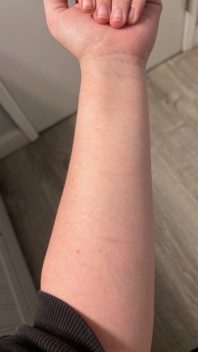 kliphed's tweet photo. you can barely tell i ever even had scars to begin with im so fucking mad #shedtwt #slittwt #twtsh https://t.co/gnHHvpkM18