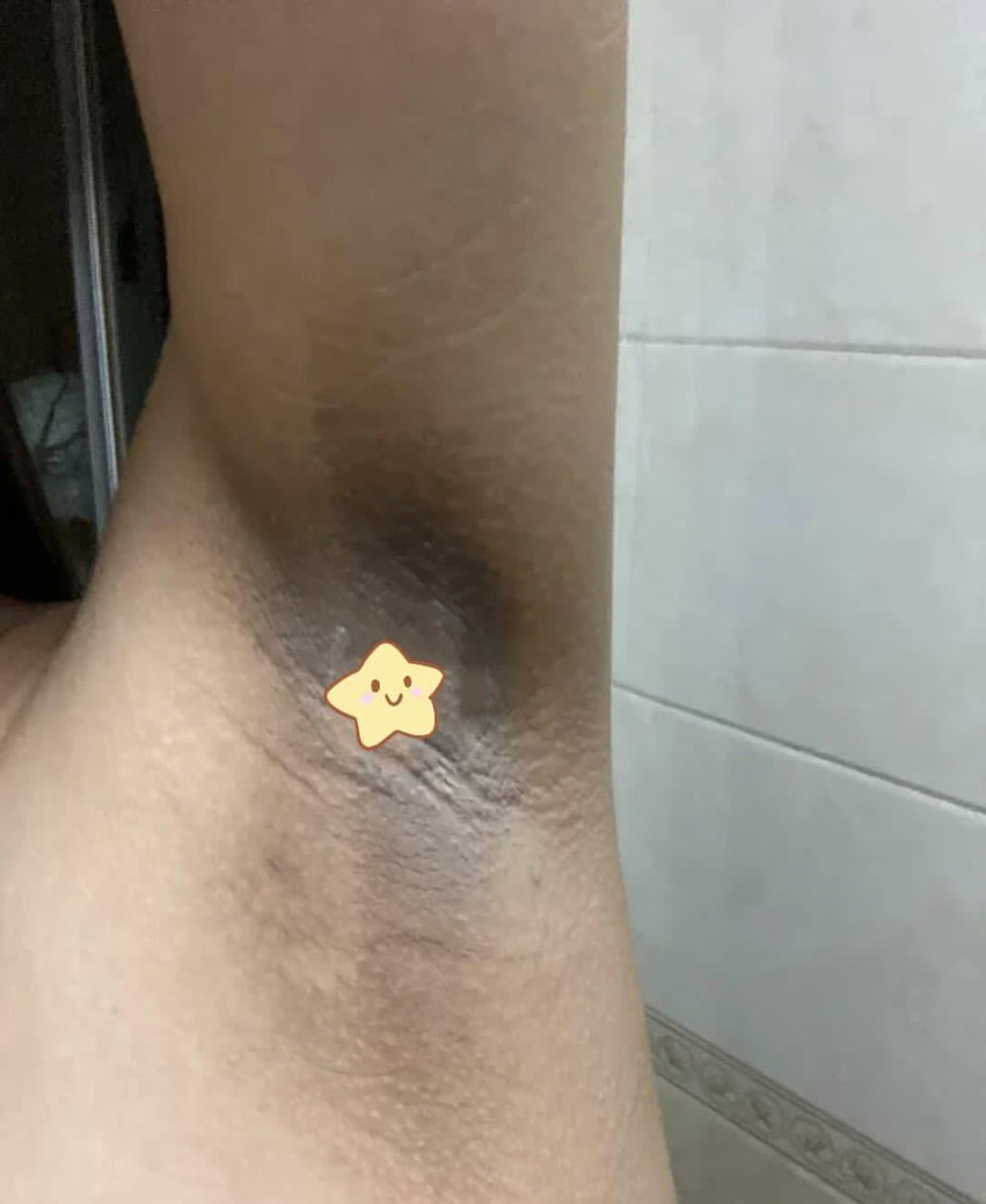 ratjunmuu's tweet photo. PLIS AKU KIRAIN INI CUMA OVERCLAIM 😭 ternyata combo ini beneran bisa bantu cerahin ketiak item yang udah bertahun-tahun susah ilang... hasilnya bikin aku speechless. https://t.co/fab62leKP5