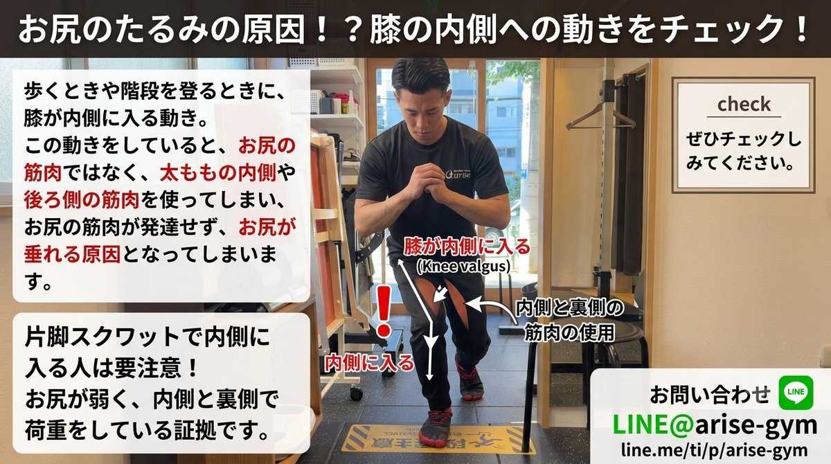ohkisekkotsuin's tweet photo. お尻のたるみの原因は実は階段の登り方にあります！！

階段を登るときに膝が内側に入っていませんか？？

この動きをしていると太もものうちや裏側の筋肉ばかり使用してしまいます。

その結果お尻が使えずお尻のたるみの原因になります。 https://t.co/qzXnF7D1Gc