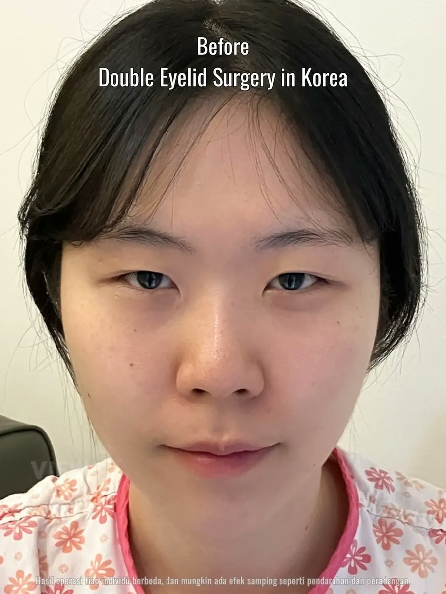 viewhospital's tweet photo. Lipatan mata punya tapi masuk kedalam dan tidak terlihat jelas. Alhasil mata jadi terlihat kecil dan kurang berbinar.🥲
Operasi double eyelid di VIEW bisa bantu kamu mengatasi hal ini loh👀

Further info, contact us on whatsapp :
🇮🇩 Bahasa Indonesia : +82 010 3936 7164
🇺🇸 English : +82 10-2103-7174

Copyrights to images and all other materials related to this content belong to VIEW and you may be liable for unauthorized distribution and or reproduction of the same without written consent.

Hasil operasi tiap individu berbeda, dan mungkin ada efek samping seperti pendarahan dan peradangan.

#korea #kplasticsurgery #kbeauty #seoul #koreanbeauty #kpop #idol #twice #mina #sana #nayeon #idolcare #plasticsurgery #koreanbeauty #glowup #betterme
