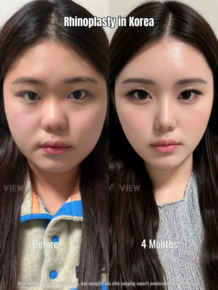 viewhospital's tweet photo. Kamu insecure dengan hidung bulat atau pesekmu? Tunggu apa lagi, segera hubungin VIEW Plastic Surgery. Kamu bisa konsultasi kapanpun tentang keluhanmu dan mendapatkan arahan terbaik untuk mewujudkan wajah impianmu✨️
Pastinya "still you, but the better version" dong💖

Further info, contact us on whatsapp :
🇮🇩 Bahasa Indonesia : +82 010 3936 7164
🇺🇸 English : +82 10-2103-7174

Copyrights to images and all other materials related to this content belong to VIEW and you may be liable for unauthorized distribution and or reproduction of the same without written consent.

Hasil operasi tiap individu berbeda, dan mungkin ada efek samping seperti pendarahan dan peradangan.

#korea #kplasticsurgery #kbeauty #seoul #koreanbeauty #kpop #idol #nmixx #jiwoo #sullyoon #idolcare #plasticsurgery #koreanbeauty #glowup #betterme