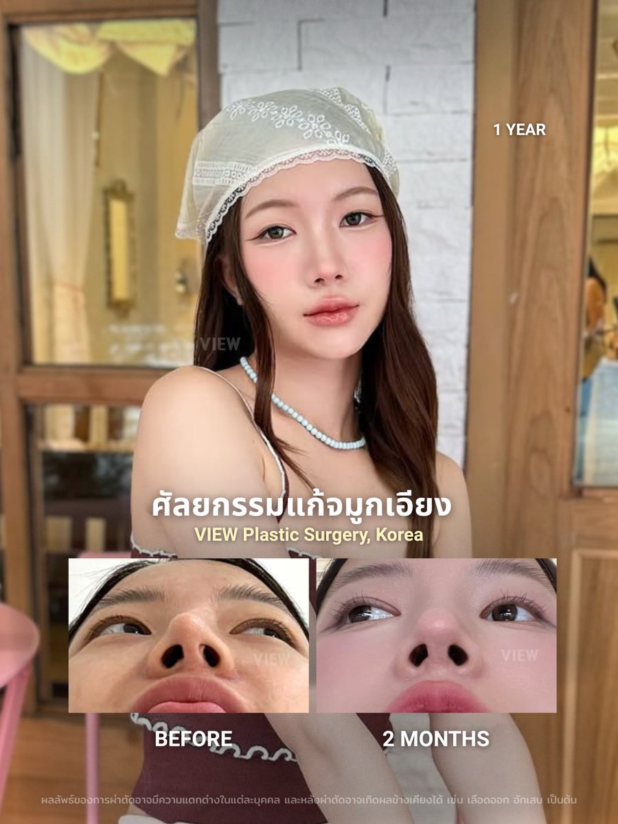 viewhospital's tweet photo. งานปรับแก้ปัญหาจมูกเอียง เพิ่มความละมุน 😍💯

💌ช่องทางติดต่อรพ.โดยตรง💌
👉 Instagram : @viewplasticsurgeryth DM
👉 Add Line : @viewps_thailand (มี@)

* ผลลัพธ์ของการผ่าตัดอาจมีความแตกต่างในแต่ละบุคคล และหลังผ่าตัดอาจเกิดผลข้างเคียงได้ เช่น เลือดออก อักเสบ เป็นต้น

* คอนเทนท์นี้เป็นลิขสิทธิ์ของโรงพยาบาลศัลยกรรมวิว ผู้ที่ไม่ได้รับอนุญาตห้ามนำไปใช้ หากฝ่าฝืนจะถูกดำเนินการตามกฎหมาย

#โรงพยาบาลวิว #viewplasticsurgery #viewplasticsurgeryรีวิว #realreviews #korea #kplasticsurgery #kbeauty #seoul #koreanbeauty #kpop #idol #blackpink #lisa #jennie #idolcare #plasticsurgery #koreanbeauty #glowup #betterme