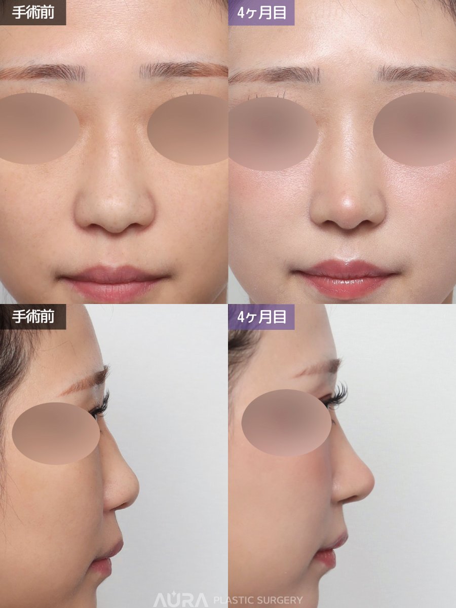 auraps2024's tweet photo. ✧ ｡ﾟ ⊹˖AURA BEFORE&AFTER ˖ ⊹ ﾟ｡ ✧

【手術内容】鼻筋＋鼻先＋無プロテーゼ（段差移植）＋骨切り幅寄せ＋鷲鼻矯正＋鞍鼻矯正+団子鼻矯正＋鼻唇角矯正（長い鼻）＋鼻柱基部突出＋陥没鼻柱矯正

正面から見たときの鼻筋や鼻先の存在感がお悩みでご来院され、無プロテーゼで手術を行いました。
鼻筋は鷲鼻を矯正し、幅の広い鼻骨は骨切り幅寄せによって自然な細さへ調整致しました。鼻先はEラインに合わせて高さを出し、団子鼻も同時に改善することで、正面から見た際の鼻の存在感を抑えました。
全体のバランスが整い、顔立ちに自然になじむ仕上がりました。正面から見たハイライトラインもより美しくなり、洗練された印象へと変化しました。

公式LINE：https://t.co/pMc2bkYBvU 

#韓国整形 #チュ先生 #ペク先生 #鼻初手術 #鼻再手術 #アウラ美容整形 #アウラ美容外科