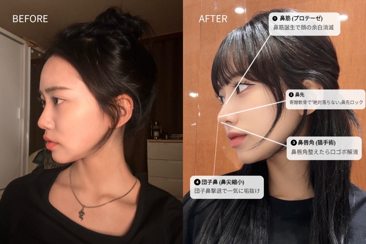 urutsuyachan's tweet photo. 鼻って本当に印象変わる…🥹
🇰🇷美女ってこういうことね...

韓国鼻整形なら個人的にはティアナ整形外科さんかな。
症例がドストライクすぎるし、カウセから手術まで院長先生が1:1で見てくれるらしい！！次の渡韓の候補に入れとこ✈️ https://t.co/nQAgg6w0dc