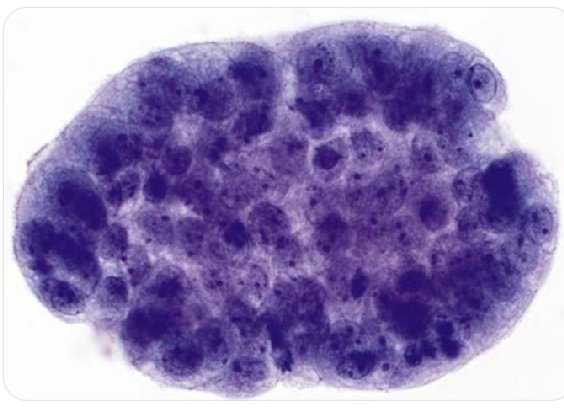 BenServiceNotes's tweet photo. ABC Of Cytology_26
2026
Creola Body

In cytology, Creola bodies are tight, three-dimensional clusters of sloughed ciliated columnar bronchial epithelial cells. The cells are said to be reactive with hyperplasia. They are most commonly seen in bronchial washings or lavage, https://t.co/5i0uuhbo1i