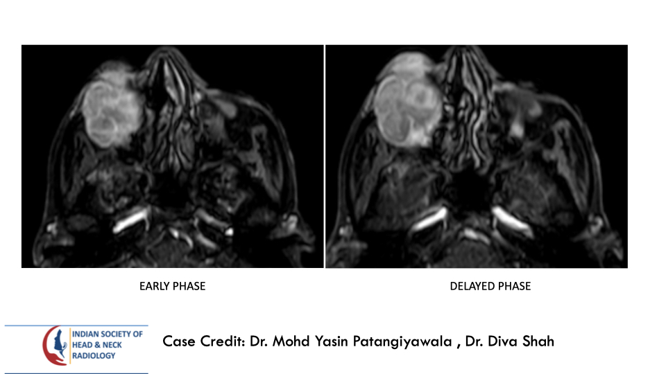 teamishnr's tweet photo. #caseoftheweekanswer
Please find the answer
#radiology #caseoftheweek #headandneck #radiologycases #dailywork #ISHNR #teaching #research #imaging #FOAM #FOAMRad #FOAMMed
Visit our website: https://t.co/PbcZcNQ4OU
All Cases: https://t.co/0xaPvoBy5H https://t.co/RpAAkYnI9p