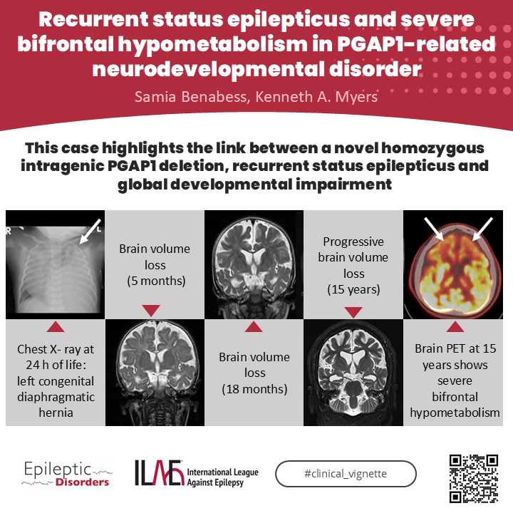 EpiDisorders's tweet photo. This rare but critical case demonstrates that pathogenic variants in PGAP1 can manifest as recurrent status epilepticus with severe bilateral frontal lobe dysfunction.  https://t.co/wDHqAolfky https://t.co/yQMb3PrWuK