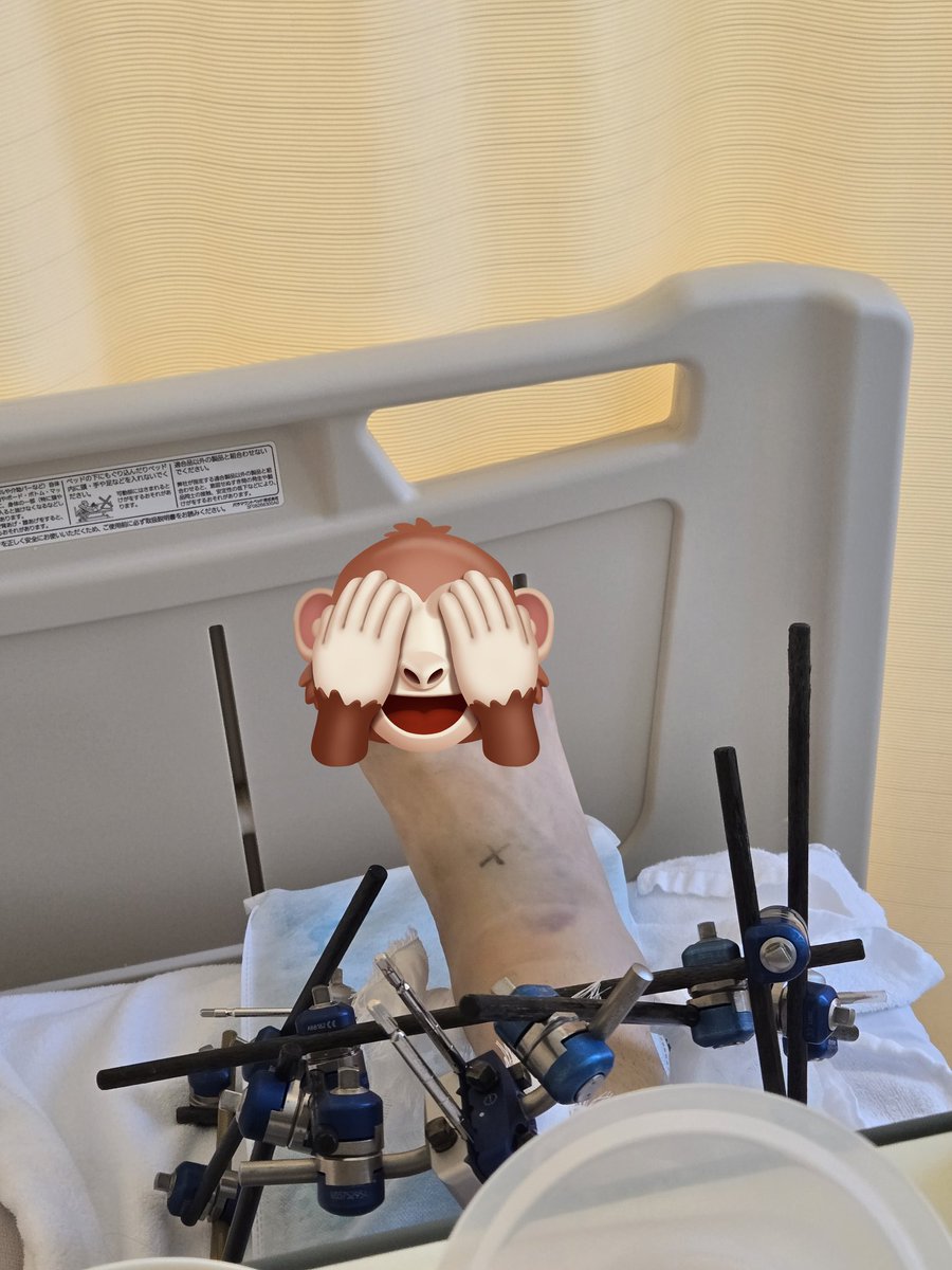 Knight__TP's tweet photo. [事の経緯とこれからの予定について]
グラスラの裏口から上がって2秒でキャリーとともに転んで骨3本がFinish
3時間ほど気絶して救急車に連絡
先程手術1回目が終了←イマココ✨

今日から18日まで入院して19日の撮影会に復活します。21日は盛大に車椅子で復活ライブしたいのでお待ちしてます。 https://t.co/AlsKTBmq8s