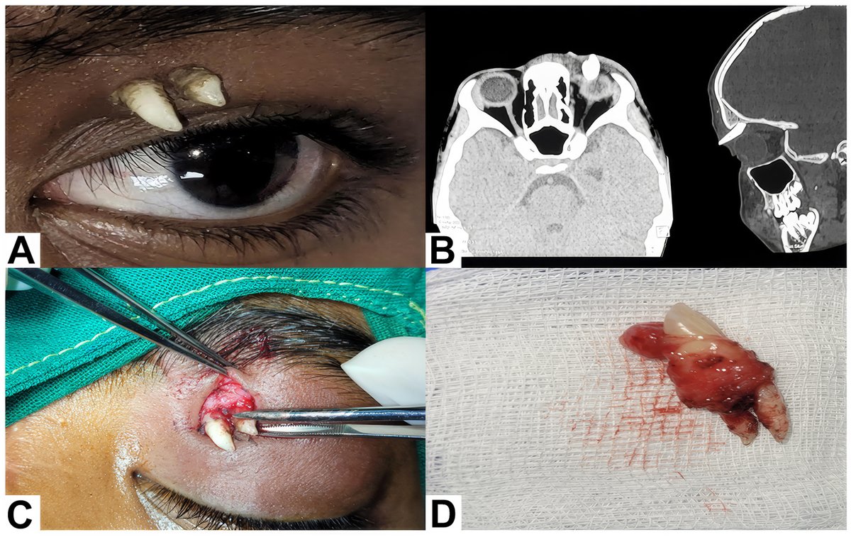 aao_ophth's tweet photo. A 16-year-old boy presented with a painless swelling of the left upper eyelid for 1 month, with no history of trauma. Examination revealed 2 hard, well-defined whitish projections arising from a fullness in the medial third of the upper eyelid (A). Computed tomography demonstrated a well-defined hyperdense structure with crown–root morphology arising from the left orbital roof, extending into the preseptal space and projecting externally with 2 tooth-like projections on its surface (B). Surgical excision revealed a mature canine tooth (C, D) without teratomatous elements, consistent with an ectopic tooth of the superior orbit.

From “Ectopic Canine Tooth in the Superior Orbit” by Meghana Tanwar, DNB, FRCS (Ophth), Vedant Sharma, MBBS, Usha Kim, DO, DNB. Published by Ophthalmology online on January 16, 2026.

Read: https://t.co/LabGO5DaHD

#AAO #Ophthalmology