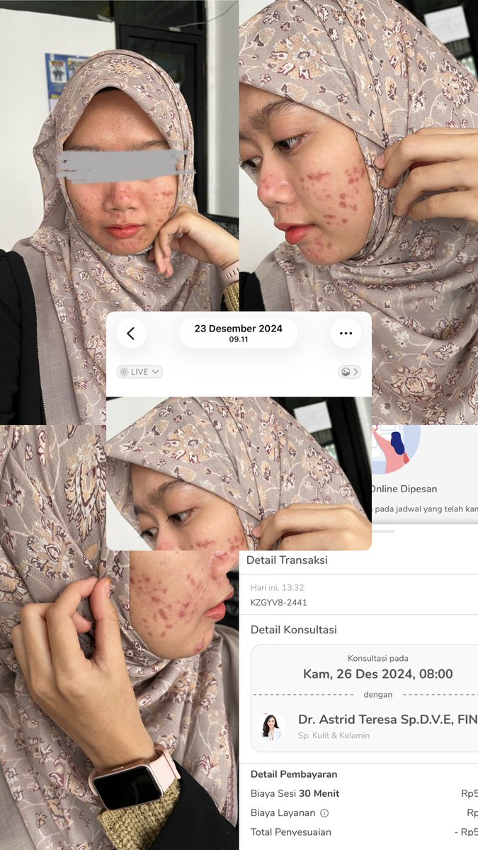 Rayasorayaa's tweet photo. mau sharing my skin journey: Acne, PIH &amp; PIE, from this to this. modalnya cuma konsisten, sabar dan pakai salep/skincare apotek hasil konsul online di Halodoc. MURAH MERIAH TANPA BIKIN KANTONG KERING

disclaimer dulu ya, ini pure pengalaman pribadi dan no endorse sama sekali￼ https://t.co/slyOYm12jk