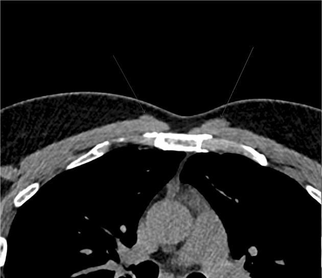 Surfin's tweet photo. 胸骨筋(sternalis muscle)と胸骨筋症候群

胸骨筋：副筋(accessory muscle)もしくは破格筋と呼ばれる、解剖学的変異の一種
本来存在するはずの筋群に加えて認められる、頻度は1-8%, モンゴロイドでは9.1%との報告も(https://t.co/FtYB9jE5WQ)
部位：乳頭より内側、胸骨の外側に位置
起始：第2〜第6肋軟骨付近の肋骨前面、大胸筋膜、腹直筋鞘など
停止：胸骨柄、鎖骨、または大胸筋の筋膜など

胸骨筋症候群：胸壁症候群の一種
胸骨筋の過緊張や筋膜性トリガーポイントによって疼痛や不快感を生じる
胸骨左縁～第3-5肋軟骨が好発部位
前傾姿勢や上肢運動などで増悪、可逆性
治療は筋・筋膜性疼痛に従い姿勢改善やストレッチ、鎮痛薬、トリガーポイント注射など
※心疾患や骨軟部疾患、悪性腫瘍の除外は必要

画像はwikipaediaより
https://t.co/uWy24Jidzt
#Rdiag